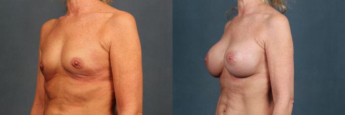 Before & After Enlargement - Silicone Case 307 View #2 View in Louisville & Lexington, KY