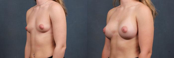 Before & After Enlargement - Silicone Case 308 View #2 View in Louisville & Lexington, KY