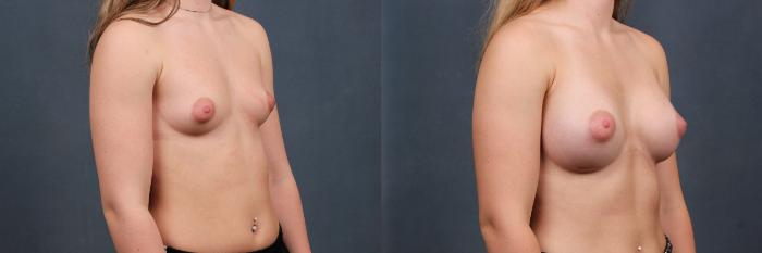 Before & After Enlargement - Silicone Case 308 View #3 View in Louisville & Lexington, KY
