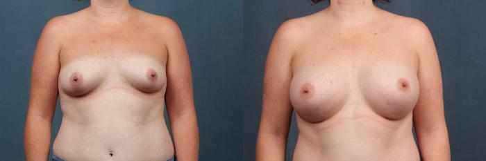 Before & After Enlargement - Silicone Case 309 View #1 View in Louisville & Lexington, KY