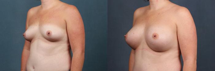 Before & After Enlargement - Silicone Case 309 View #2 View in Louisville & Lexington, KY