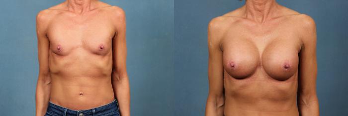 Before & After Enlargement - Silicone Case 310 View #1 View in Louisville & Lexington, KY