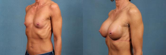 Before & After Enlargement - Silicone Case 310 View #3 View in Louisville & Lexington, KY