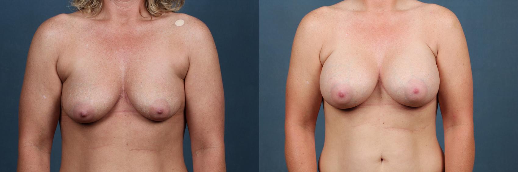 Before & After Enlargement - Silicone Case 311 View #1 View in Louisville & Lexington, KY