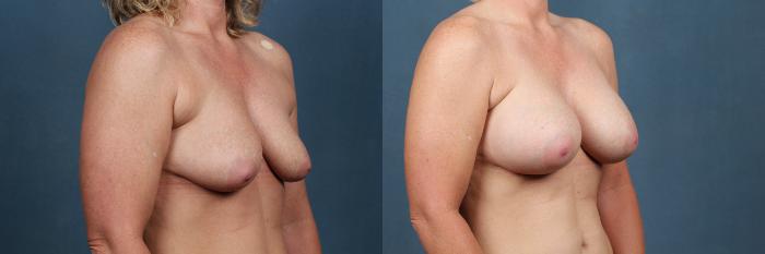 Before & After Enlargement - Silicone Case 311 View #2 View in Louisville & Lexington, KY