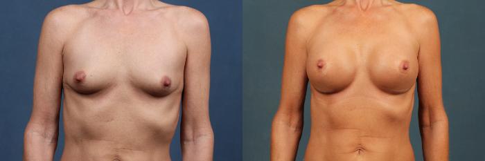 Before & After Enlargement - Silicone Case 313 View #1 View in Louisville & Lexington, KY