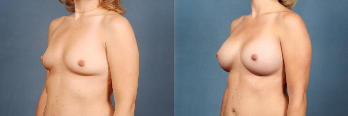Before & After Enlargement - Silicone Case 316 View #2 View in Louisville & Lexington, KY