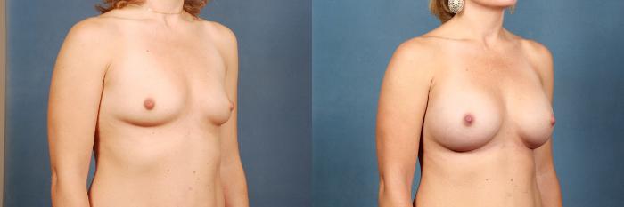 Before & After Enlargement - Silicone Case 316 View #3 View in Louisville & Lexington, KY