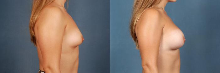 Before & After Enlargement - Silicone Case 317 View #3 View in Louisville & Lexington, KY