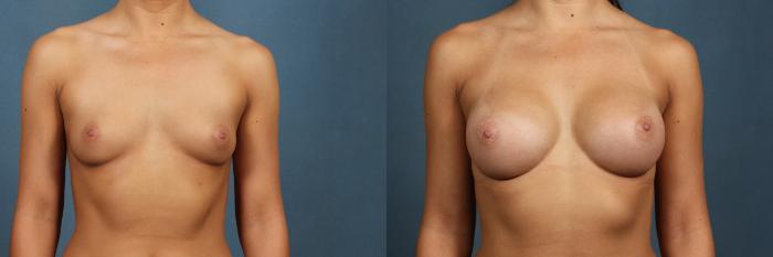 Before & After Enlargement - Silicone Case 319 View #1 View in Louisville & Lexington, KY