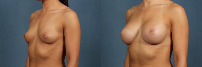 Before & After Enlargement - Silicone Case 319 View #3 View in Louisville & Lexington, KY