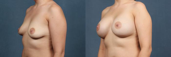 Before & After Enlargement - Silicone Case 321 View #1 View in Louisville & Lexington, KY