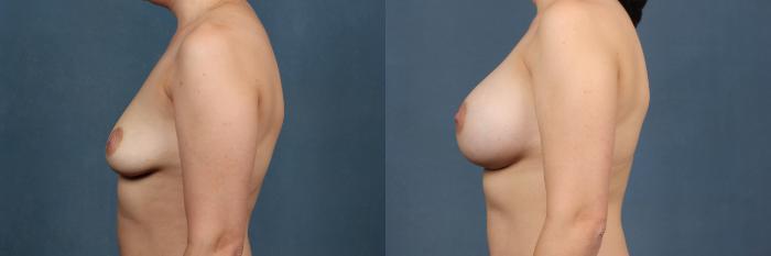 Before & After Enlargement - Silicone Case 321 View #2 View in Louisville & Lexington, KY