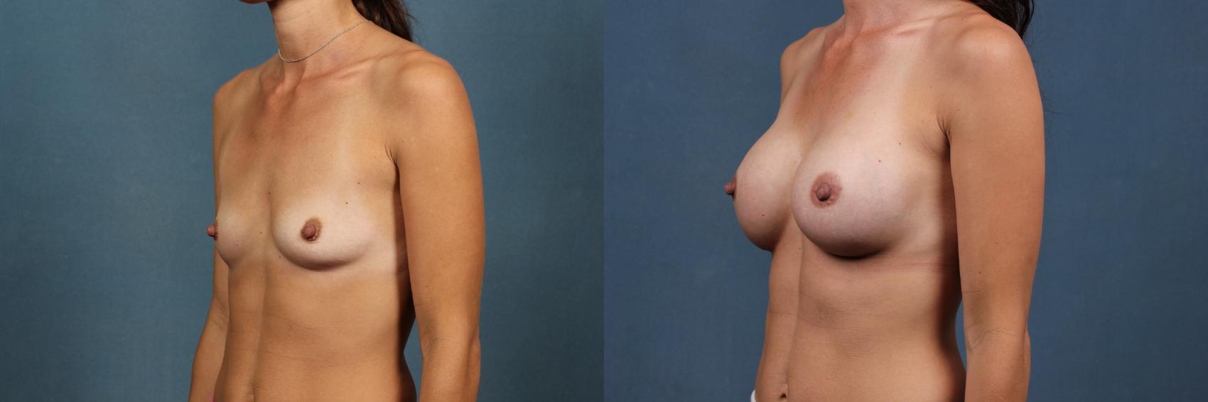 Before & After Enlargement - Silicone Case 323 View #2 View in Louisville & Lexington, KY