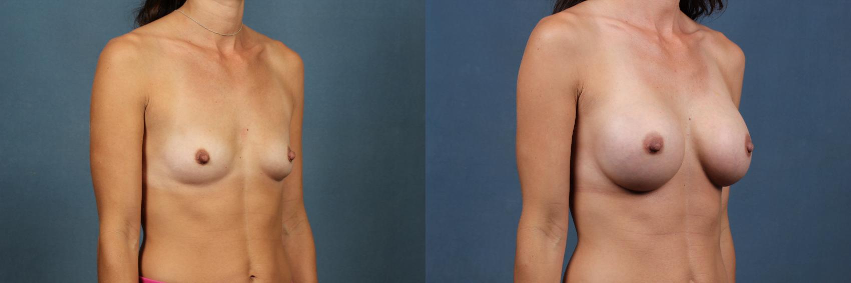 Before & After Enlargement - Silicone Case 323 View #4 View in Louisville & Lexington, KY