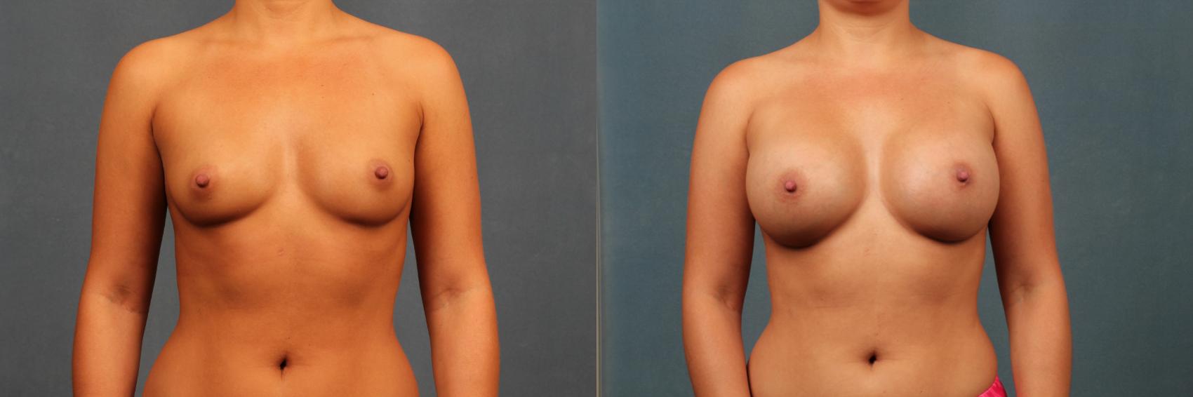 Before & After Enlargement - Silicone Case 324 View #1 View in Louisville & Lexington, KY