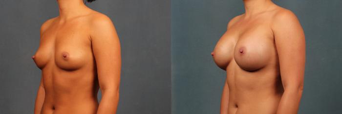 Before & After Enlargement - Silicone Case 324 View #2 View in Louisville & Lexington, KY