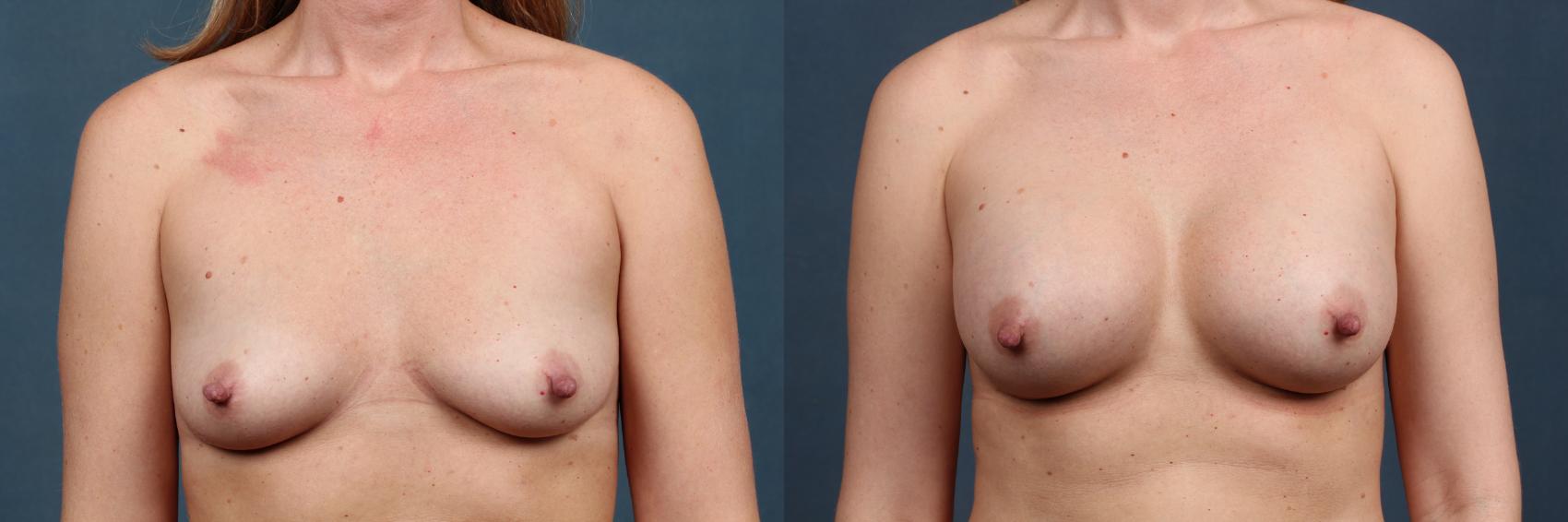Before & After Enlargement - Silicone Case 326 View #1 View in Louisville & Lexington, KY