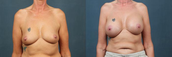 Before & After Enlargement - Silicone Case 327 View #1 View in Louisville & Lexington, KY