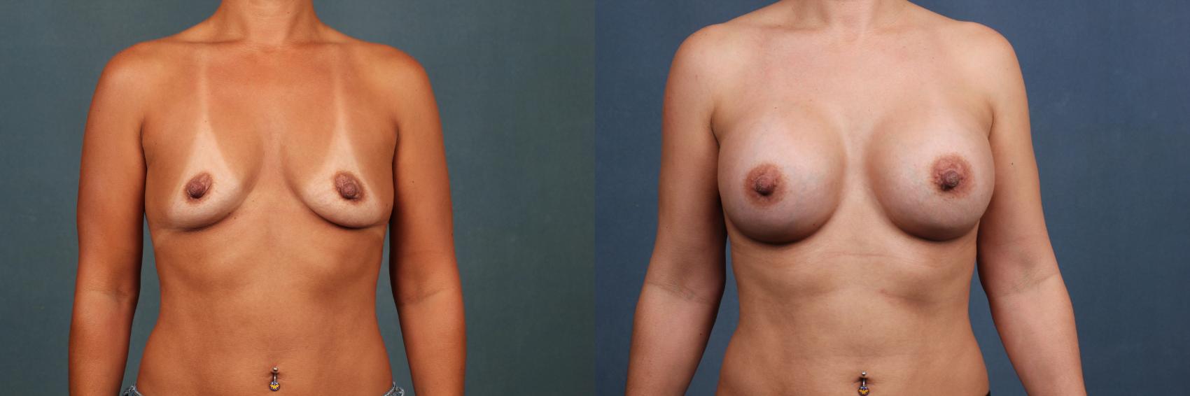 Before & After Enlargement - Silicone Case 328 View #1 View in Louisville & Lexington, KY