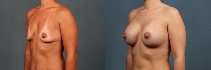 Before & After Enlargement - Silicone Case 328 View #2 View in Louisville & Lexington, KY