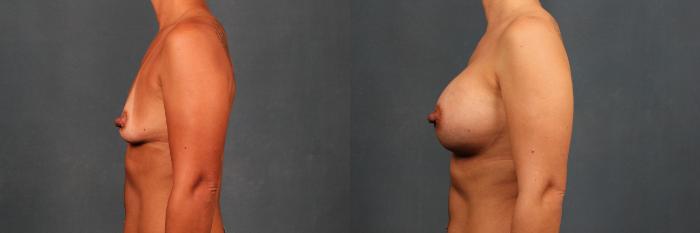Before & After Enlargement - Silicone Case 328 View #3 View in Louisville & Lexington, KY