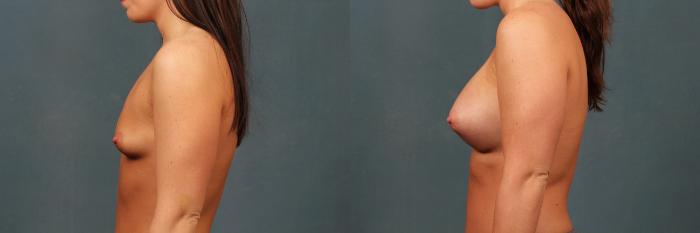 Before & After Enlargement - Silicone Case 329 View #3 View in Louisville & Lexington, KY