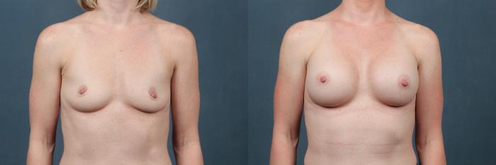 Before & After Enlargement - Silicone Case 330 View #1 View in Louisville & Lexington, KY