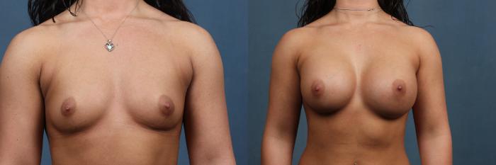 Before & After Enlargement - Silicone Case 331 View #1 View in Louisville & Lexington, KY