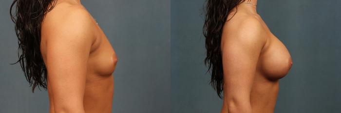 Before & After Enlargement - Silicone Case 331 View #3 View in Louisville & Lexington, KY