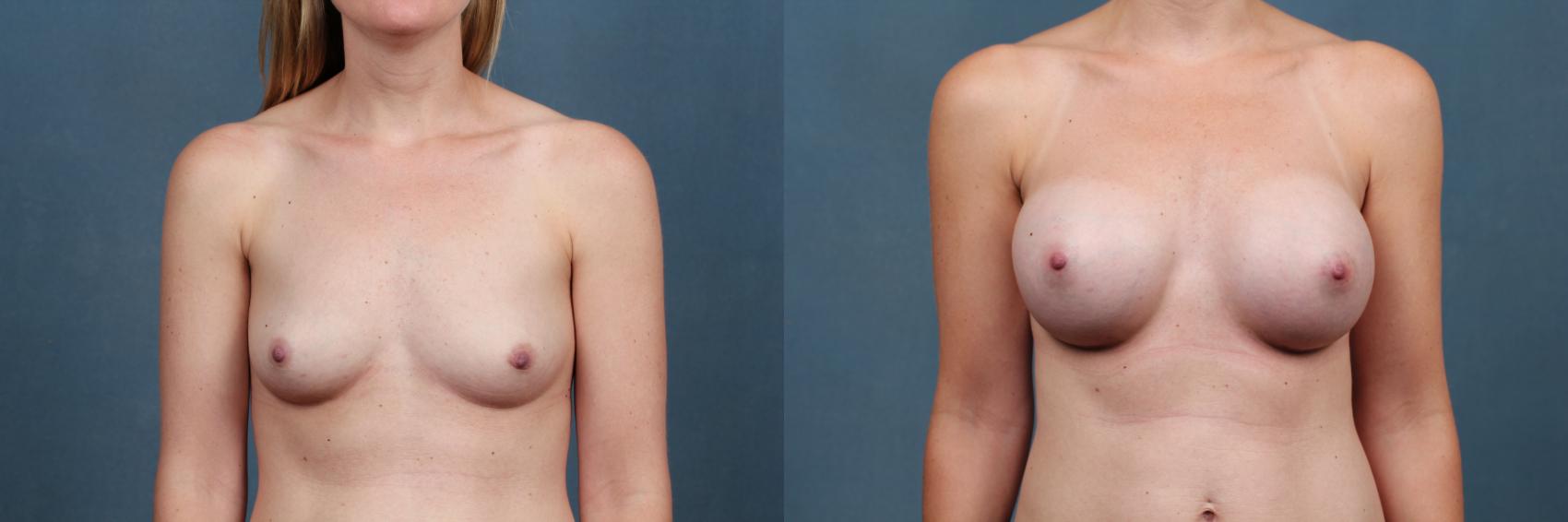 Before & After Enlargement - Silicone Case 332 View #1 View in Louisville & Lexington, KY