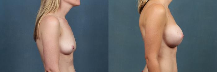 Before & After Enlargement - Silicone Case 332 View #3 View in Louisville & Lexington, KY