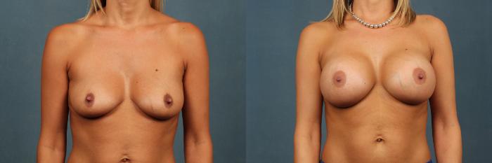 Before & After Enlargement - Silicone Case 333 View #1 View in Louisville & Lexington, KY