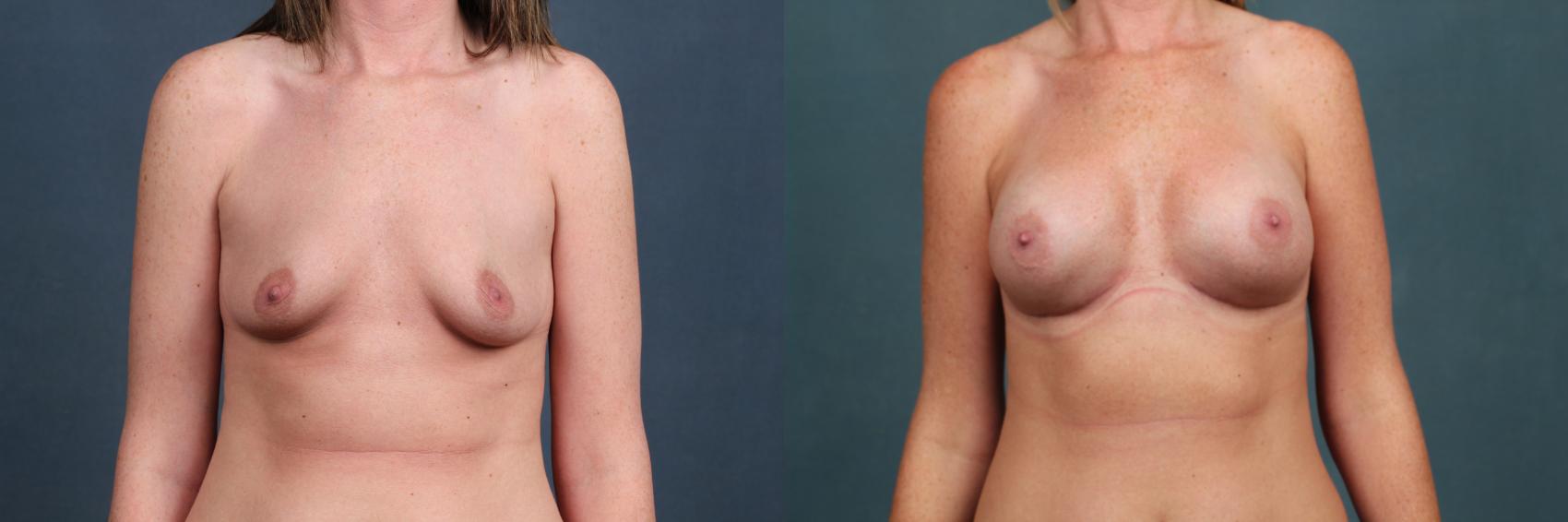 Before & After Enlargement - Silicone Case 334 View #1 View in Louisville & Lexington, KY