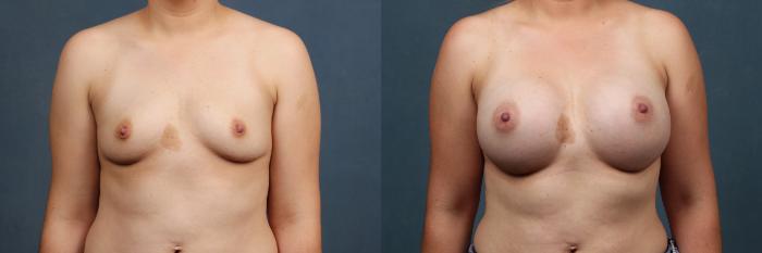 Before & After Enlargement - Silicone Case 336 View #1 View in Louisville & Lexington, KY