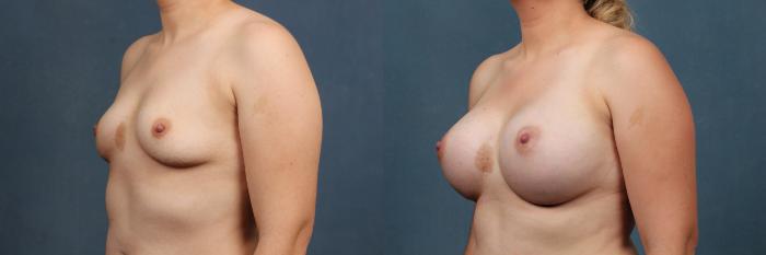 Before & After Enlargement - Silicone Case 336 View #2 View in Louisville & Lexington, KY