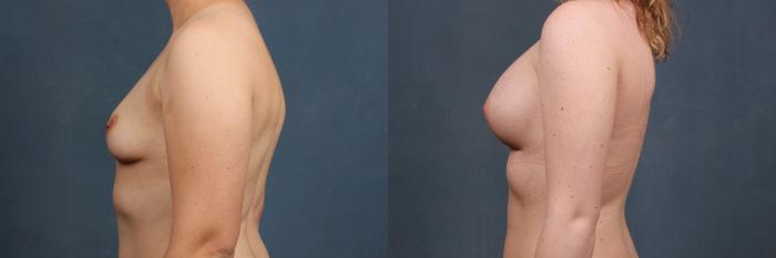 Before & After Enlargement - Silicone Case 336 View #3 View in Louisville & Lexington, KY
