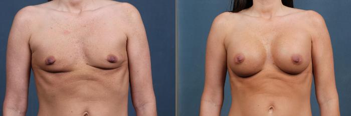 Before & After Enlargement - Silicone Case 338 View #1 View in Louisville & Lexington, KY