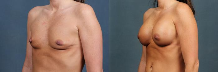 Before & After Enlargement - Silicone Case 338 View #2 View in Louisville & Lexington, KY