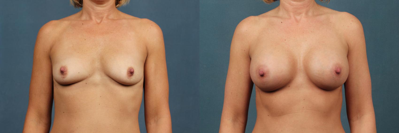 Before & After Enlargement - Silicone Case 339 View #1 View in Louisville & Lexington, KY