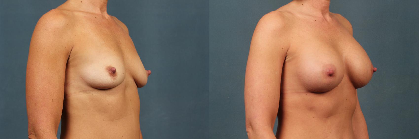 Before & After Enlargement - Silicone Case 339 View #2 View in Louisville & Lexington, KY