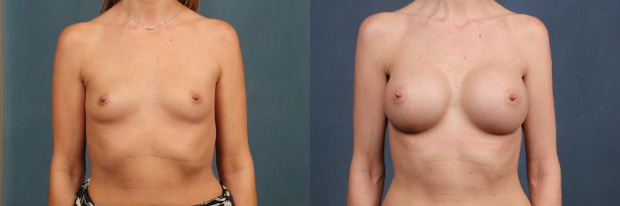 Before & After Enlargement - Silicone Case 341 View #1 View in Louisville & Lexington, KY