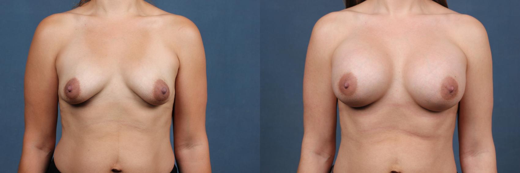 Before & After Enlargement - Silicone Case 343 View #1 View in Louisville & Lexington, KY