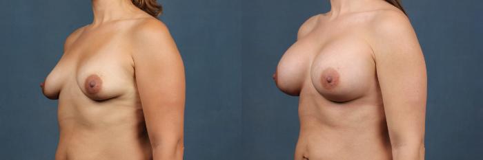 Before & After Enlargement - Silicone Case 343 View #3 View in Louisville & Lexington, KY