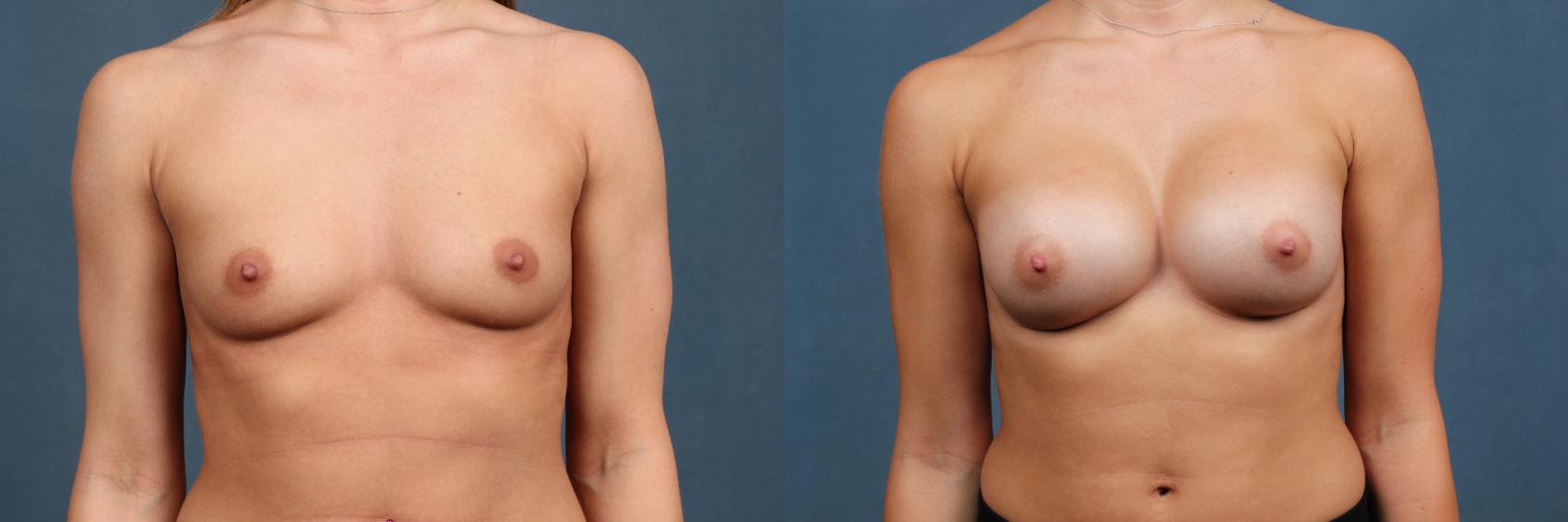Before & After Enlargement - Silicone Case 345 View #1 View in Louisville & Lexington, KY