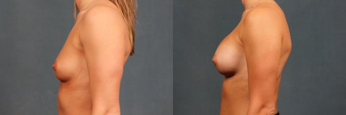 Before & After Enlargement - Silicone Case 345 View #3 View in Louisville & Lexington, KY