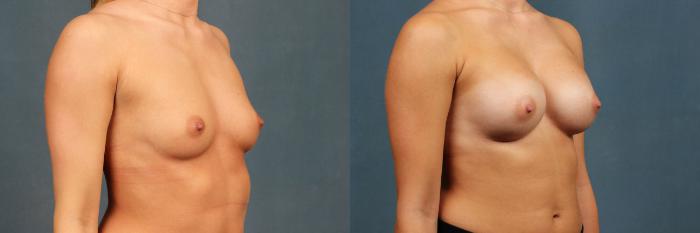 Before & After Enlargement - Silicone Case 345 View #4 View in Louisville & Lexington, KY