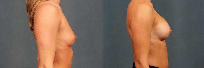 Before & After Enlargement - Silicone Case 345 View #5 View in Louisville & Lexington, KY