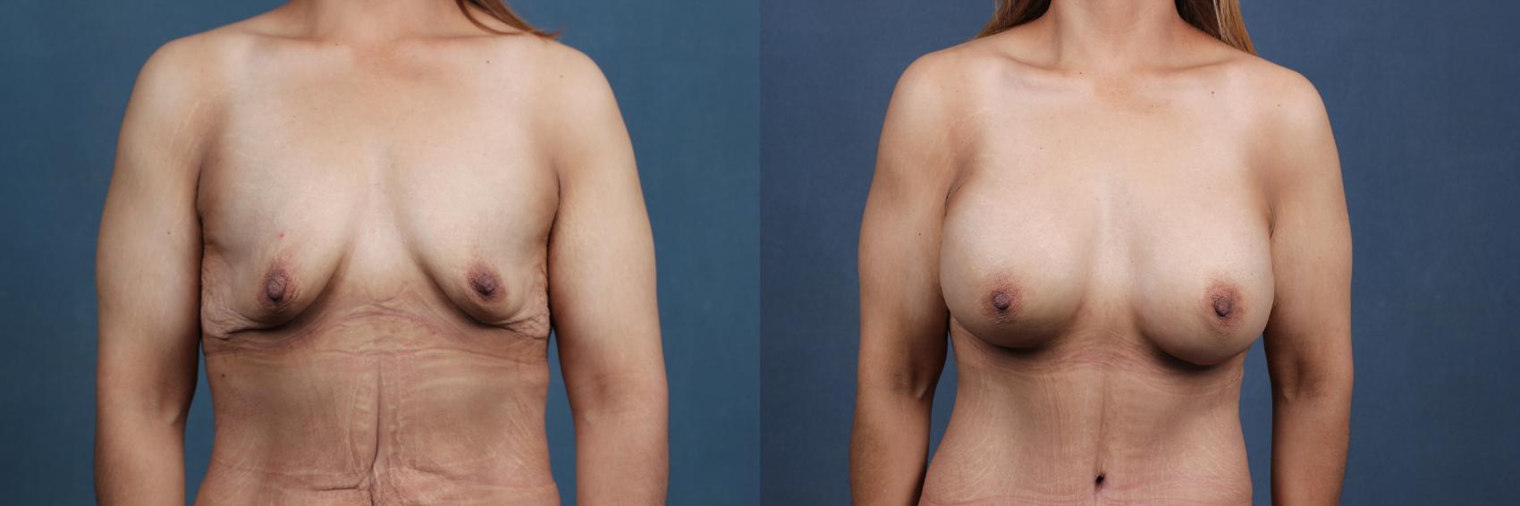 Before & After Enlargement - Silicone Case 346 View #1 View in Louisville & Lexington, KY