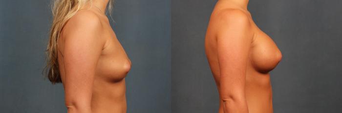 Before & After Enlargement - Silicone Case 347 View #3 View in Louisville & Lexington, KY